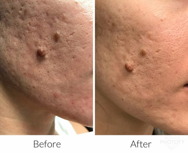 Subcision For Acne Scar Revision In Manchester NH