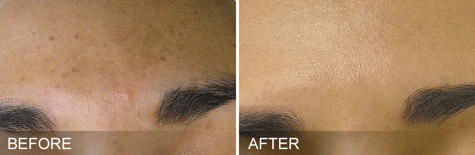 hydrafacial-1-before-and-afters-pelle-medical-spa-manchester-nh