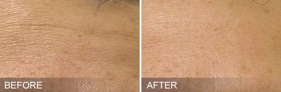 hydrafacial-3-before-and-afters-pelle-medical-spa-manchester-nh