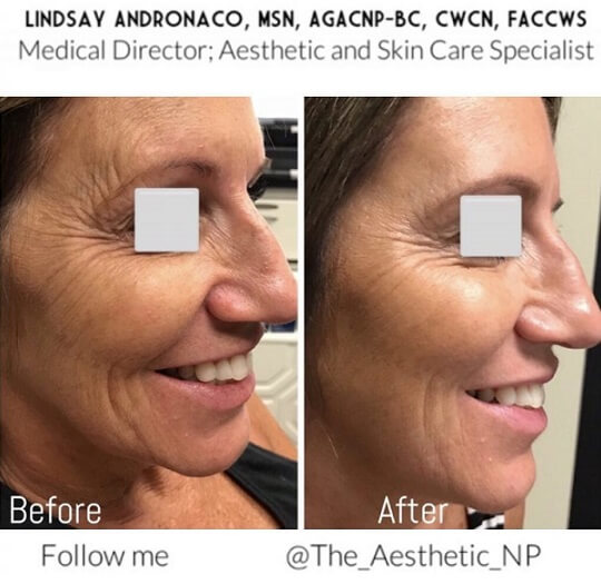 a-patient-of-plasma-pen-treatment-before-and-after