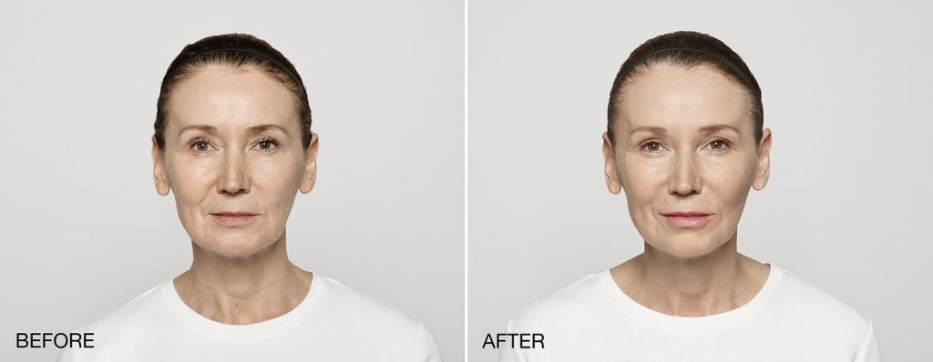 restylane-before-and-afters-pelle-medical-spa-manchester-nh-1