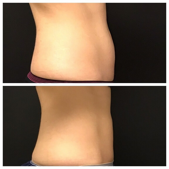 CoolSculpting-before-and-after-results-pelle-medical-spa-manchester-nh-2