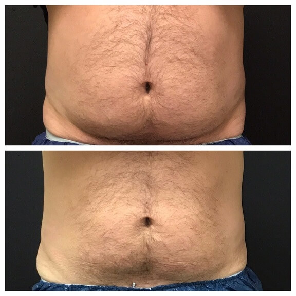 CoolSculpting-before-and-after-results-pelle-medical-spa-manchester-nh-3