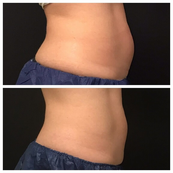 CoolSculpting-before-and-after-results-pelle-medical-spa-manchester-nh-4