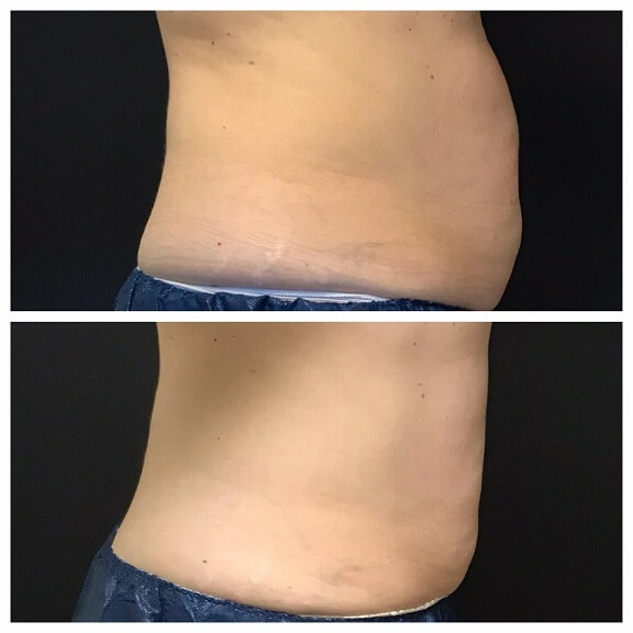 CoolSculpting-before-and-after-results-pelle-medical-spa-manchester-nh-5