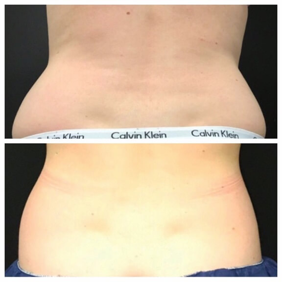 CoolSculpting-before-and-after-results-pelle-medical-spa-manchester-nh-6
