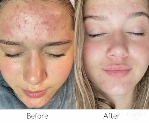 Hydrafacial-before-and-after-results-pelle-medical-spa-manchester-nh-5