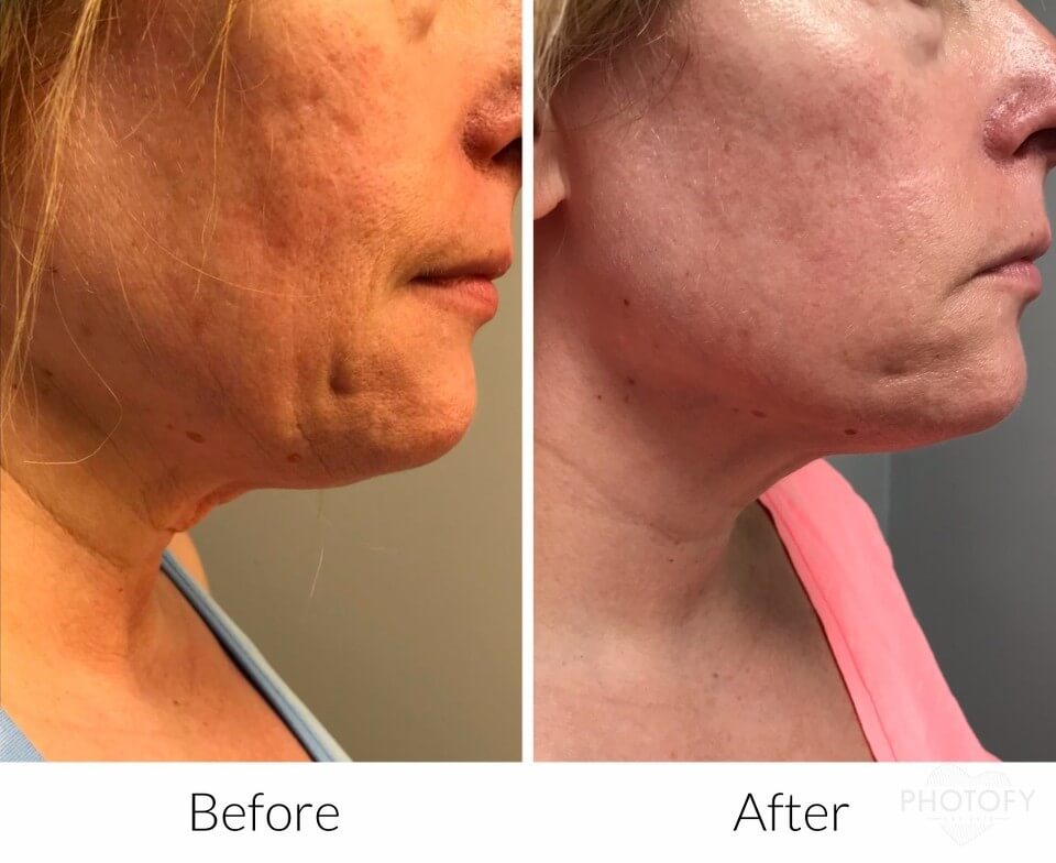 Subcision-before-and-after-results-pelle-medical-spa-manchester-nh-1