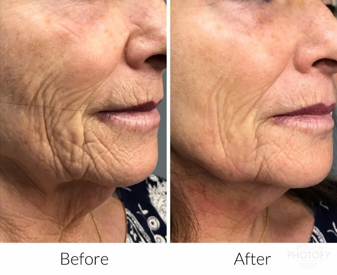 Sylfirm-before-and-after-results-pelle-medical-spa-manchester-nh-2