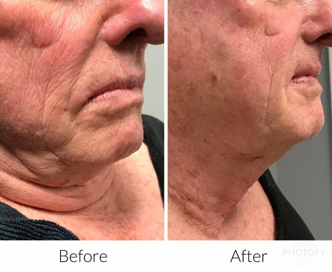 Sylfirm-before-and-after-results-pelle-medical-spa-manchester-nh-6