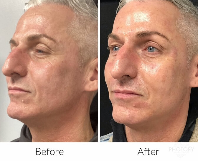aquagold-before-and-after-results-pelle-medical-spa-manchester-nh-1