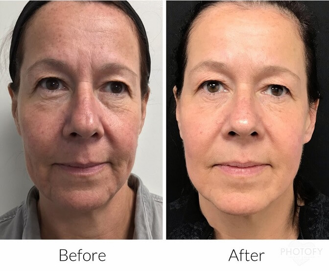 aquagold-before-and-after-results-pelle-medical-spa-manchester-nh-2