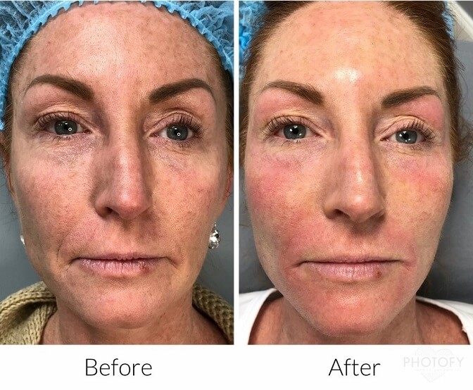 aquagold-before-and-after-results-pelle-medical-spa-manchester-nh-3