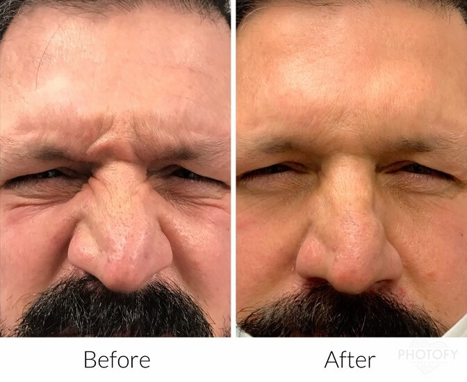 botox-before-and-afters-results-pelle-medical-spa-manchester-nh-5