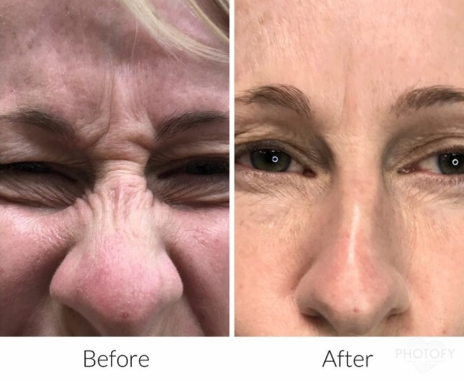 botox-before-and-afters-results-pelle-medical-spa-manchester-nh-6