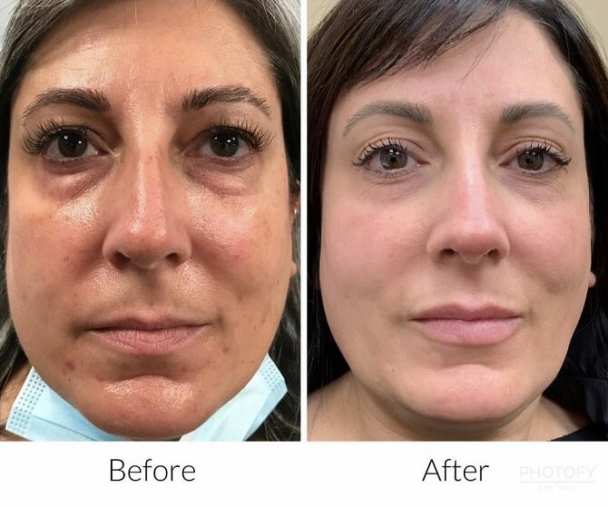 chemical-peels-before-and-after-results-pelle-medical-spa-manchester-nh-3