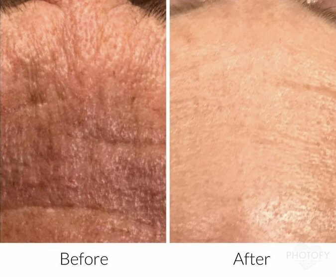 chemical-peels-before-and-after-results-pelle-medical-spa-manchester-nh-4