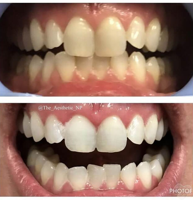 davinci-teeth-whitening-before-and-after-results-pelle-medical-spa-manchester-nh-4