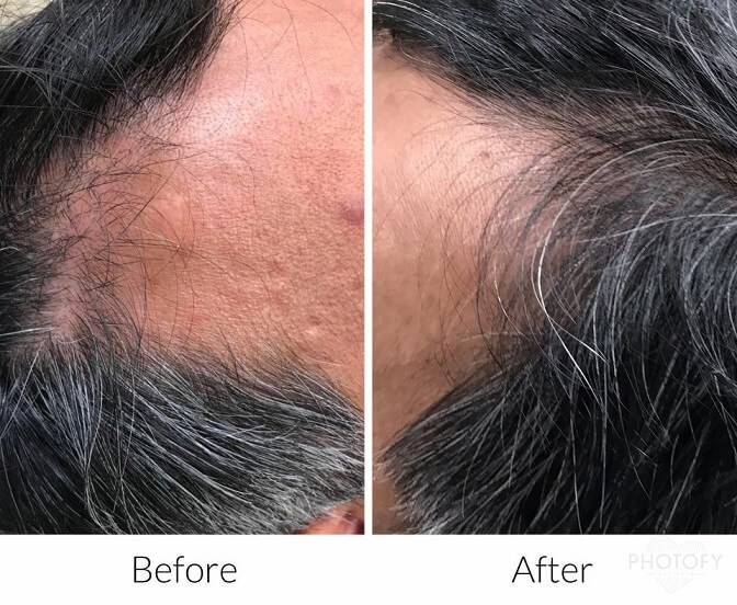 hair-restoration-before-and-after-results-pelle-medical-spa-manchester-nh-1