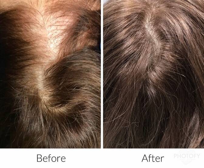 hair-restoration-before-and-after-results-pelle-medical-spa-manchester-nh-3