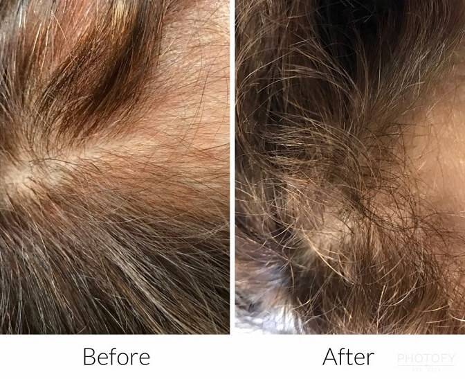 hair-restoration-before-and-after-results-pelle-medical-spa-manchester-nh-5