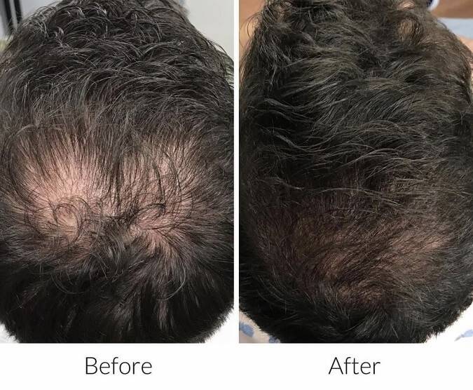 hair-restoration-before-and-after-results-pelle-medical-spa-manchester-nh-6