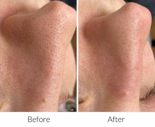 hydrafacial-before-and-after-results-pelle-medical-spa-manchester-nh-1