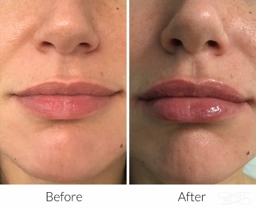 juvederm-filler-before-and-after-results-pelle-medical-spa-manchester-nh-2