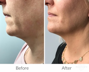juvederm-filler-before-and-after-results-pelle-medical-spa-manchester-nh-3
