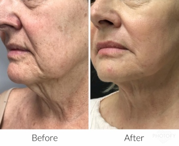juvederm-filler-before-and-after-results-pelle-medical-spa-manchester-nh-4