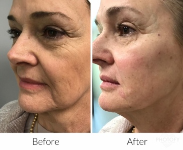 juvederm-filler-before-and-after-results-pelle-medical-spa-manchester-nh-5