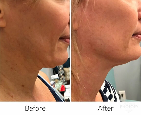 kybella-before-and-after-results-pelle-medical-spa-manchester-nh-1