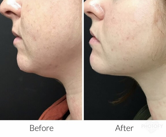 kybella-before-and-after-results-pelle-medical-spa-manchester-nh-3