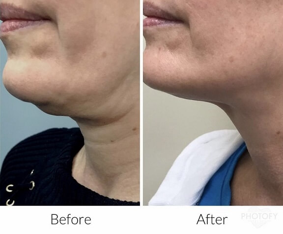 kybella-before-and-after-results-pelle-medical-spa-manchester-nh-4