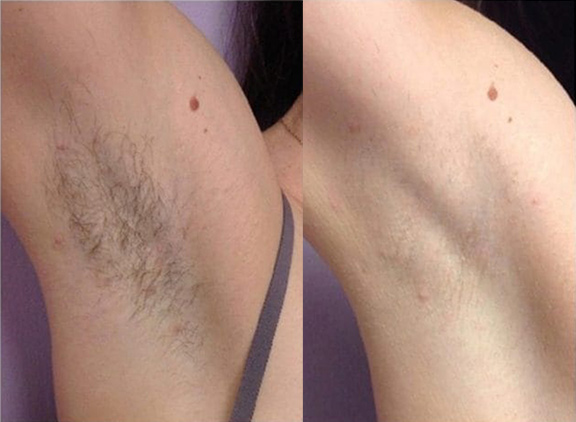 laser-hair-removal-before-and-after-results-pelle-medical-spa-manchester-nh-1