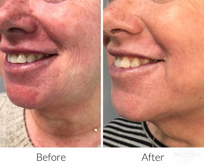 microneedling-before-and-after-results-pelle-medical-spa-manchester-nh-1
