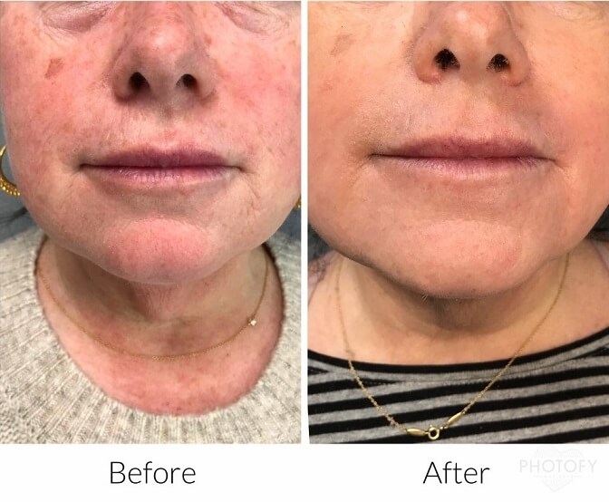 microneedling-before-and-after-results-pelle-medical-spa-manchester-nh-2