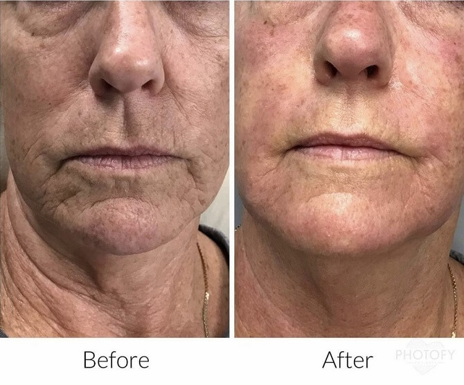 microneedling-before-and-after-results-pelle-medical-spa-manchester-nh-3