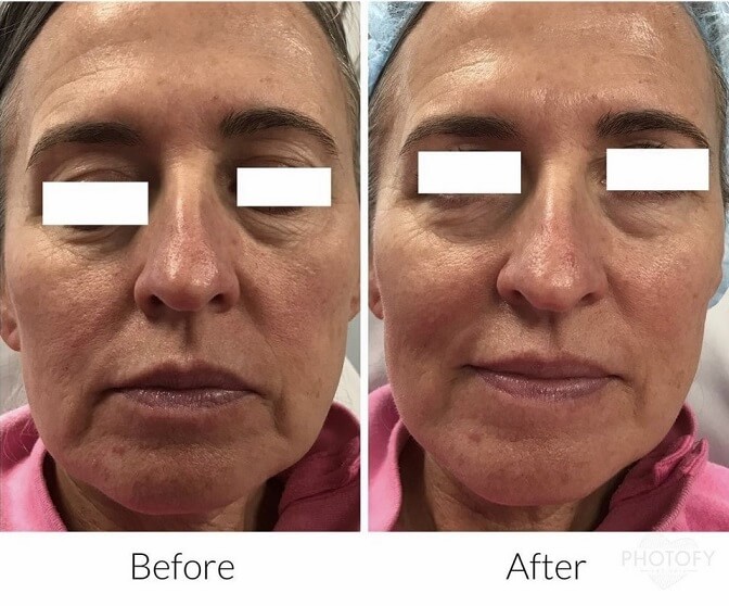 plasma-facial-before-and-after-results-pelle-medical-spa-manchester-nh-1