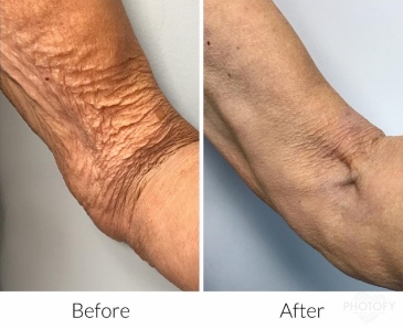 Before and after photos of Plasma pen showing a reduced sagginess of the skin on the arm.
