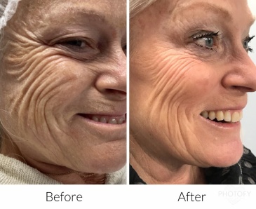 Plasma pen before and after photos of a woman's face showing a reduced wrinkles.