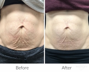 Plasma pen before and after photos of a woman's belly showing a reduced sagging skin.