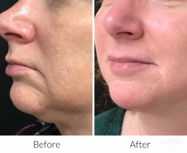 restylane-fillers-before-and-after-results-pelle-medical-spa-manchester-nh-1