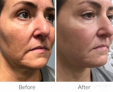 restylane-fillers-before-and-after-results-pelle-medical-spa-manchester-nh-2