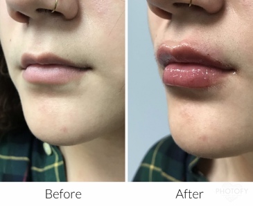 restylane-fillers-before-and-after-results-pelle-medical-spa-manchester-nh-3