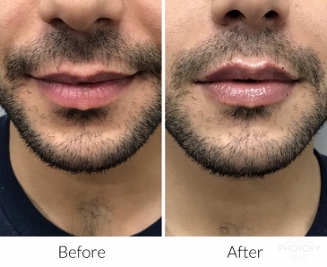 restylane-fillers-before-and-after-results-pelle-medical-spa-manchester-nh-4