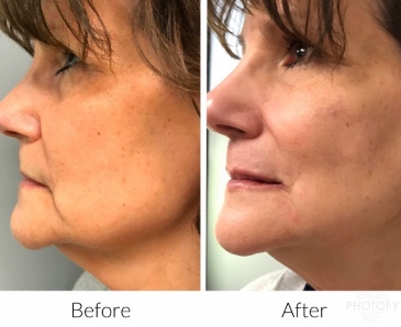 restylane-fillers-before-and-after-results-pelle-medical-spa-manchester-nh-5