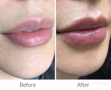 restylane-fillers-before-and-after-results-pelle-medical-spa-manchester-nh-6