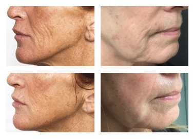 wiqo-facelift-prx-t33-before-and-after-results-pelle-medical-spa-manchester-nh