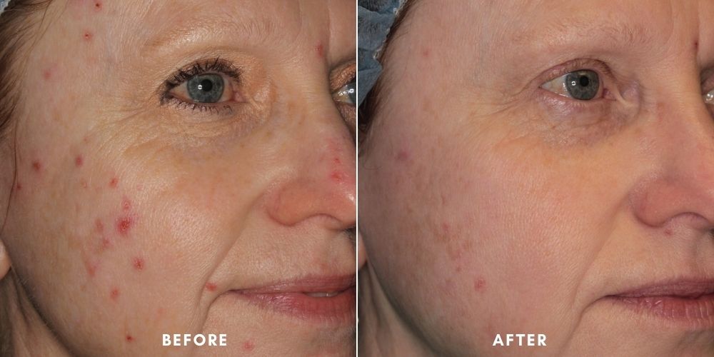 forever-clear-bbl-before-and-after-treatment